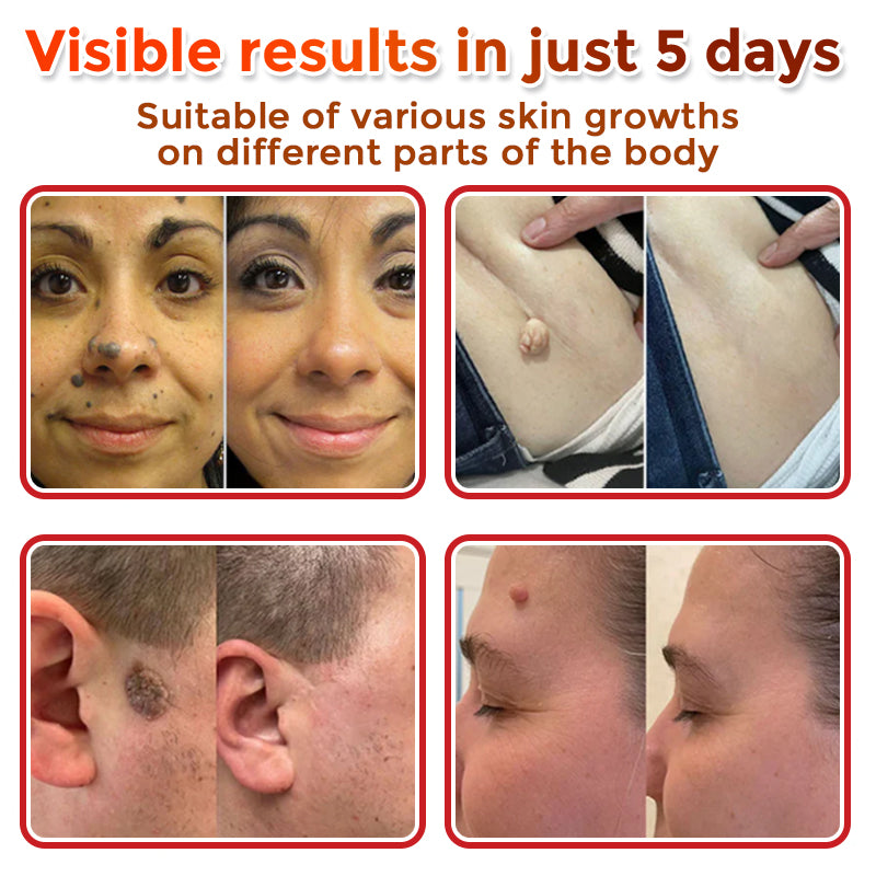 🌿 GFOUK® MicroNeedle Botanic Skin Tag Removal Patch 🇬🇧 Aligned with NHS Skincare Guidance