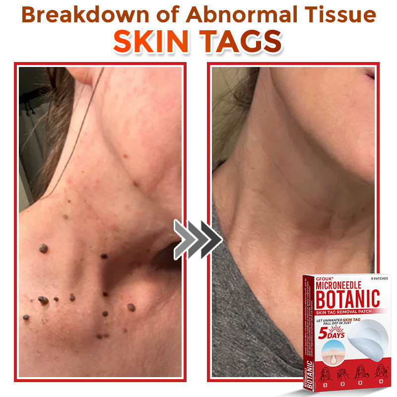 🌿 GFOUK® MicroNeedle Botanic Skin Tag Removal Patch 🇬🇧 Aligned with NHS Skincare Guidance