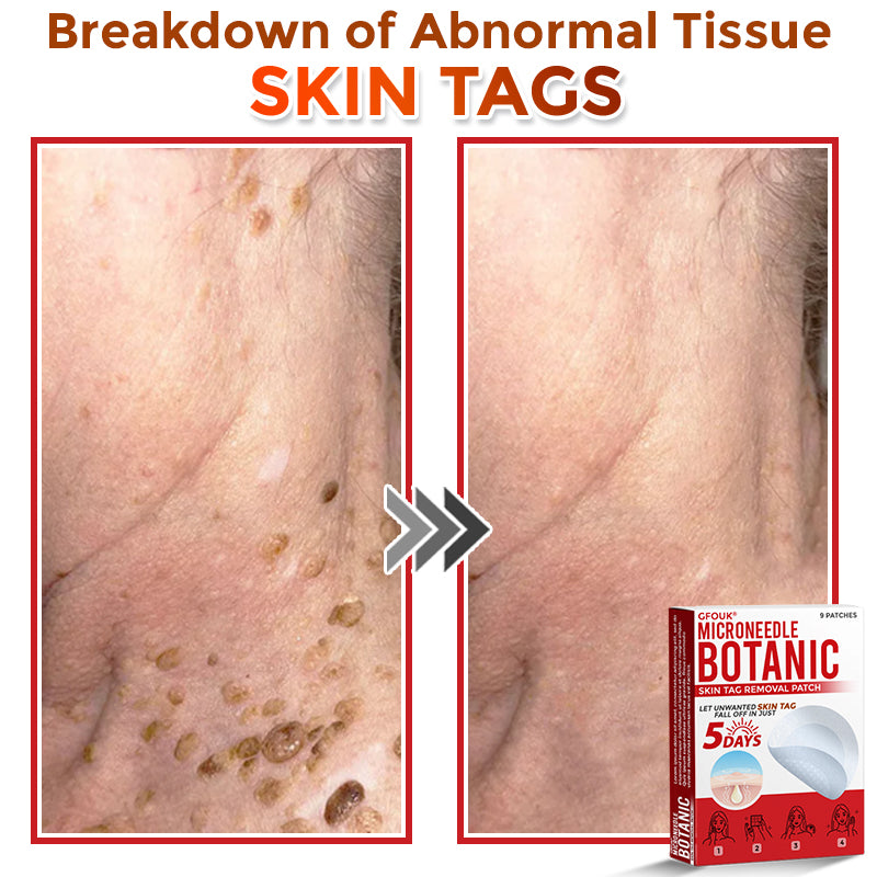 🌿 GFOUK® MicroNeedle Botanic Skin Tag Removal Patch 🇬🇧 Aligned with NHS Skincare Guidance