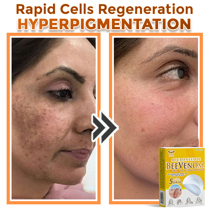 🐝✨ GFOUK® Bee Venom MicroNeedle Botanic Skin Tag Removal Patch 🇬🇧 Made in the UK