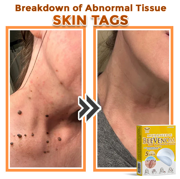 🐝✨ GFOUK® Bee Venom MicroNeedle Botanic Skin Tag Removal Patch 🇬🇧 Made in the UK